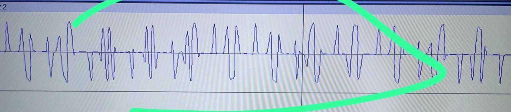 Contaminated LTC waveform